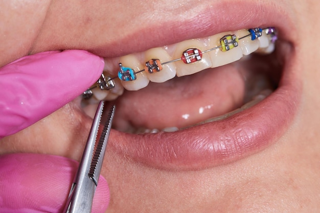 Procedimiento dental para instalar aparatos ortopédicos cerrar el procedimiento para el cuidado de dientes y encías en el m