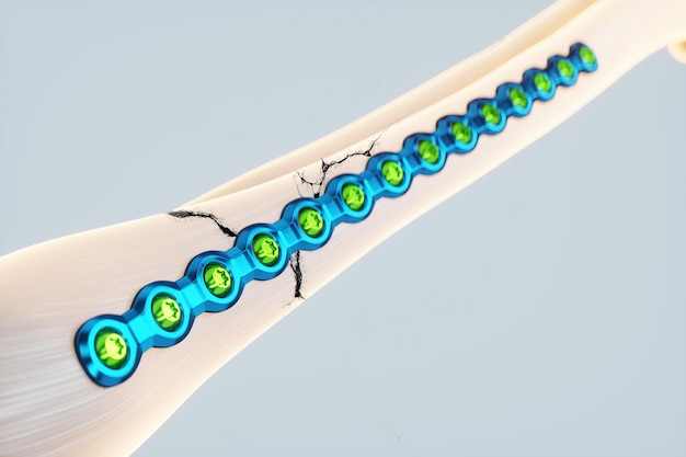 Procedimiento médico operación de osteosíntesis reposición quirúrgica Fijación de un hueso roto con una tecnología de placa de metal medicina del futuro fijación de una fractura 3D render 3D ilustración