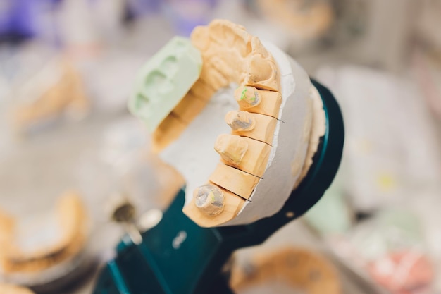 El proceso de elaboración de una prótesis dental en un laboratorio dental