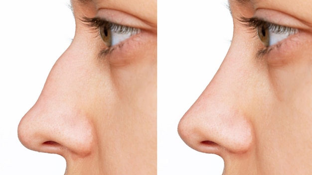Profil des Gesichts einer Frau mit Nase vor und nach der Rhinoplastik. Korrektur der Nasenscheidewand