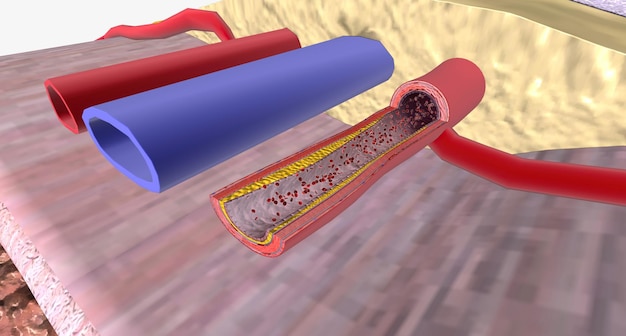 Foto progresión de la aterosclerosis en el pene