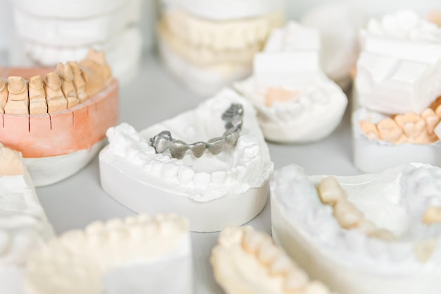 Prótese de metal em gesso de dentes humanos