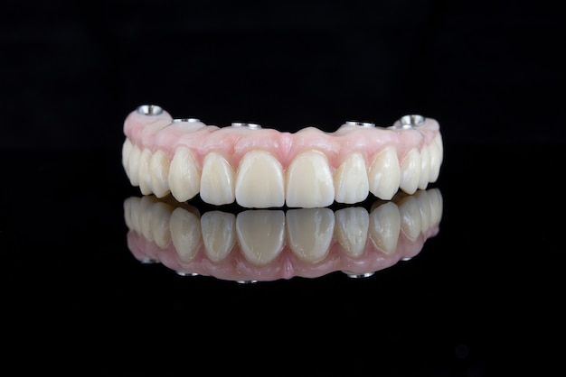 Foto prótese dentária de qualidade feita de feixe de titânio e cerâmica para fixação na mandíbula superior