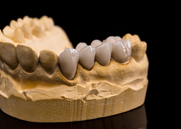 prótesis dentales de cerámica