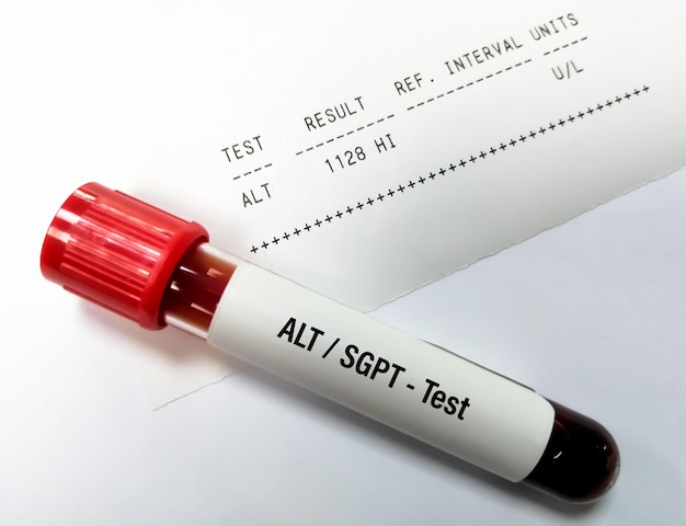 Prueba ALT para prueba de función hepática con informe de paciente anormal