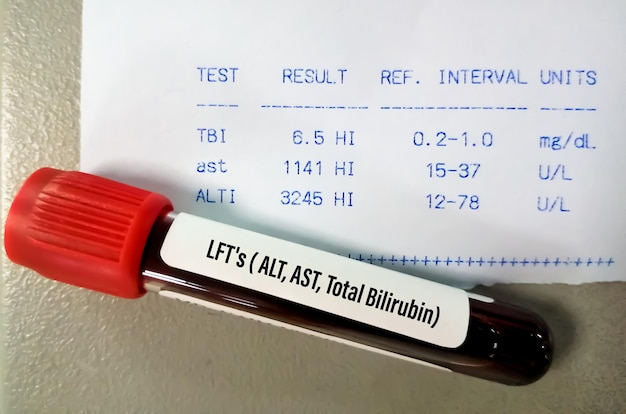Prueba de función hepática o LFT que incluyen ALT AST Bilirrubina total con informe de paciente anormal