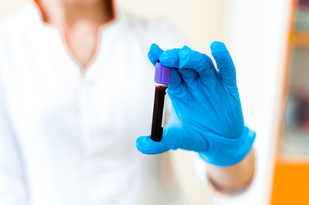 Prueba de muestra de sangre en la mano de una mujer técnico en el laboratorio. La mano de la mujer en un guante azul protector sostiene un pequeño vial de sangre