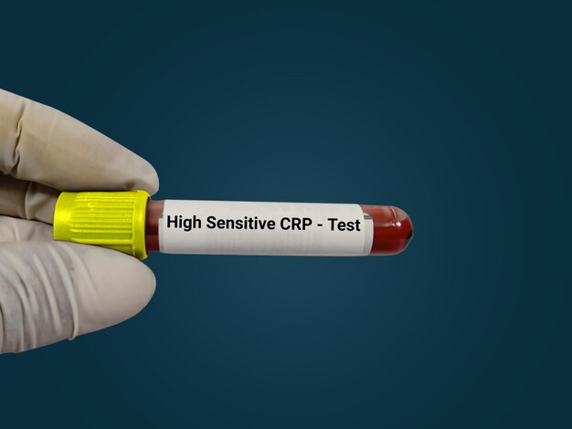 Prueba de sangre de CRP de alta sensibilidad