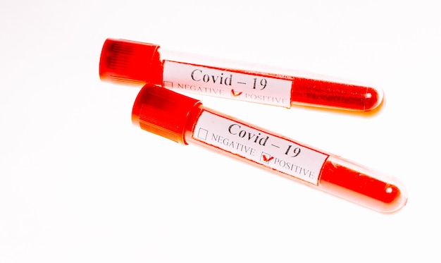 Pruebas de sangre positivas para coronavirus en tubos de ensayo.