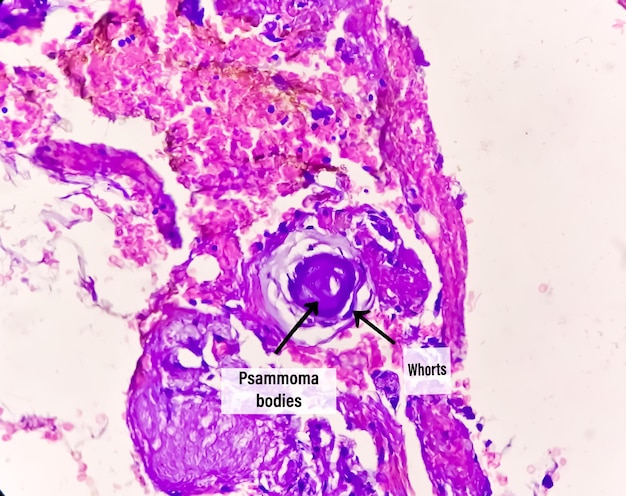 Psammom-Körper. Spinale Tumorbiopsie. Psammomatöses Meningiom.