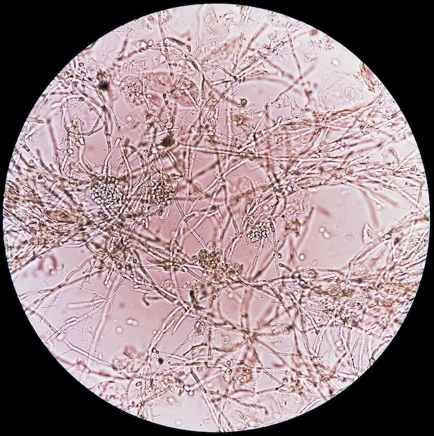 Foto pseudohifas y células de levadura en ciernes en infecciones del tracto urinario de orina de pacientes por microscopía