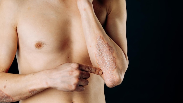 Foto la psoriasis aguda en los codos es una enfermedad dermatológica incurable autoinmune de la piel una gran erupción escamosa inflamada roja en los codos las articulaciones afectadas por la artritis psoriásica