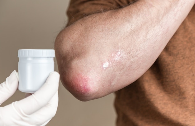 Psoriasis-Salbe. Ein Dermatologe in Handschuhen trägt eine therapeutische Salbe auf die betroffene Haut eines Patienten mit Psoriasis auf. Behandlung von chronischen Dermatosen, Ekzemen, Dermatitis