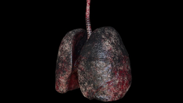 Pulmones humanos de fumador