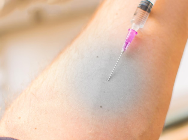 Foto una puñalada en el brazo el efecto de la necrosis en la inyección.