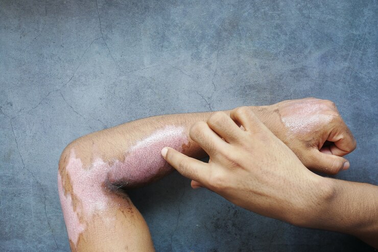 Foto queimaduras na mão do homem na superfície preta