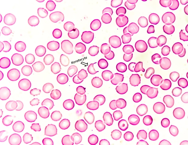 Foto queratocito célula de cuerno rbc fragmentado un tipo de esquistocito que generalmente indica enfermedad