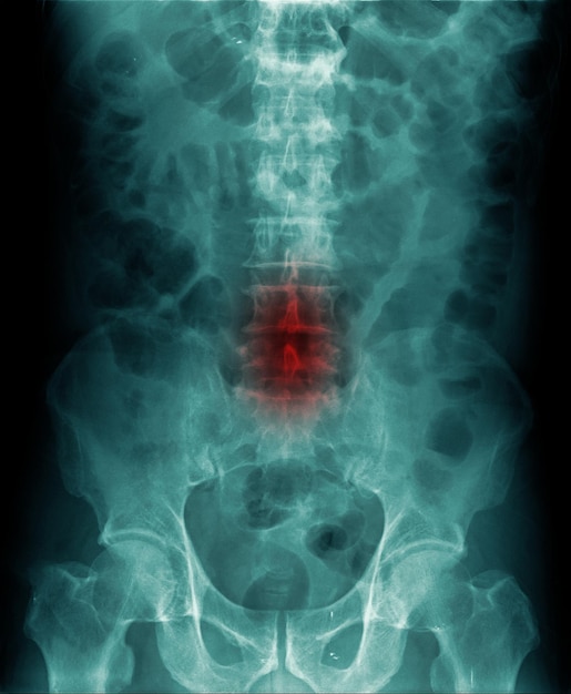 Radiografía abdominal muestra espondilosis lumbar o cambio degenerativo