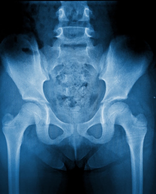 Una radiografía azul de una cadera con la palabra hueso en ella