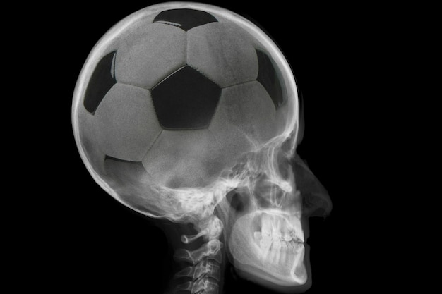 Radiografía de cráneo con balón de fútbol en el interior