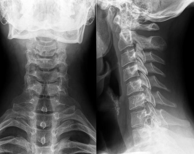 Radiografía de cuello y columna cervical