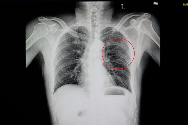 Radiografia de tórax de um paciente injuriado na parede torácica