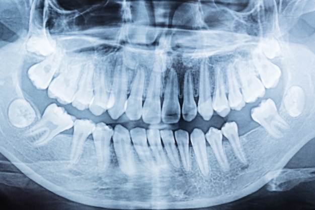 Radiografía dental panorámica de una boca izquierda y derecha.