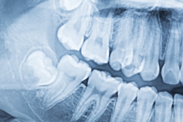 Radiografía dental panorámica de una boca izquierda y derecha.