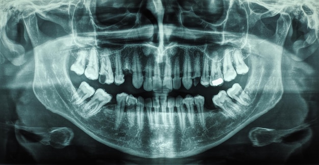 Foto radiografía de dientes humanos