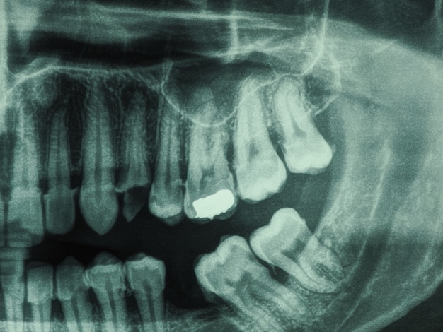 Foto radiografía de dientes humanos