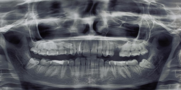 Radiografía de dientes