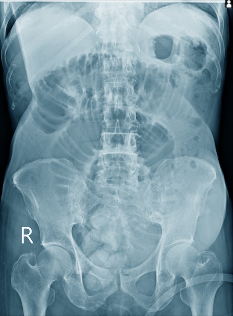 Radiografia do abdome inteiro