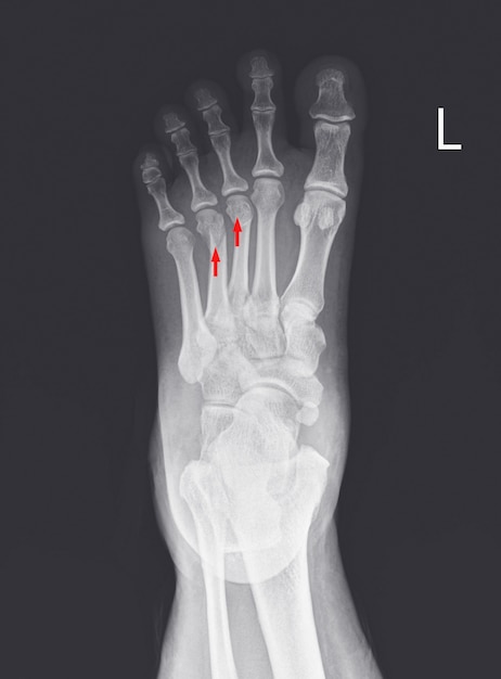 Radiografia do pé e tornozelo mostrando fraturas do metatarso.