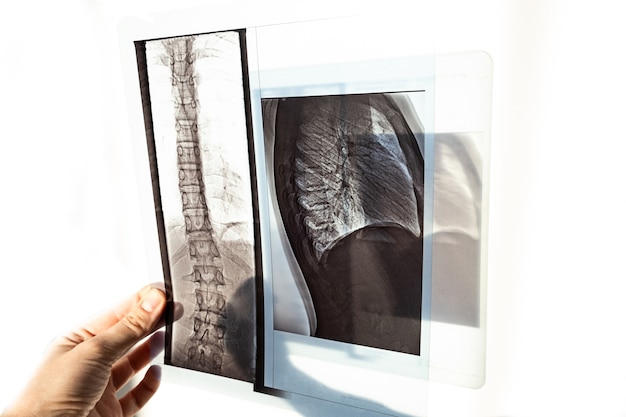 Radiografia dos ossos da parte posterior das vértebras, pulmões e tórax em caso de escoleose e curvatura da coluna vertebral.