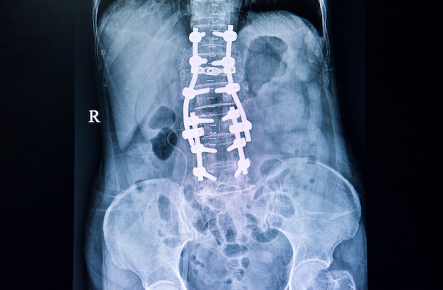 Radiografía de la espalda de un paciente con laminectomía.