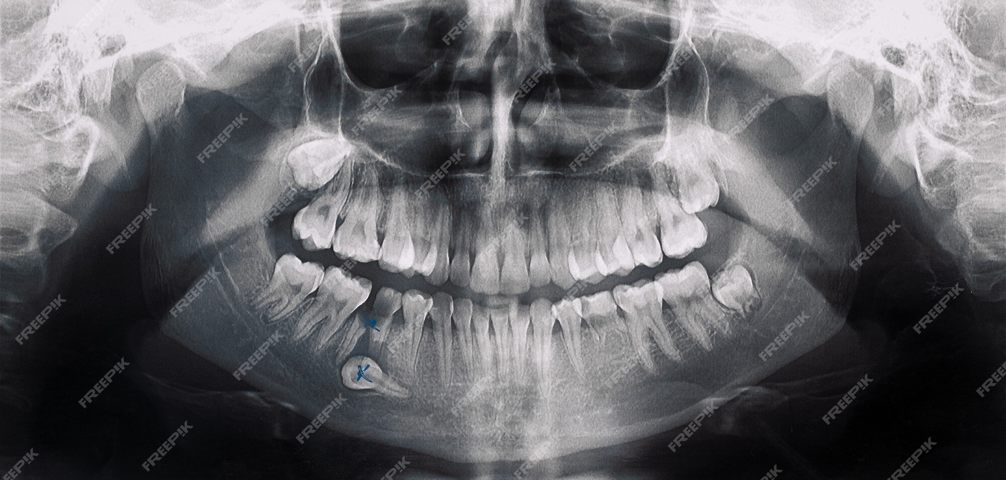 Página 3  Maxilar Mandibula Imagens – Download Grátis no Freepik