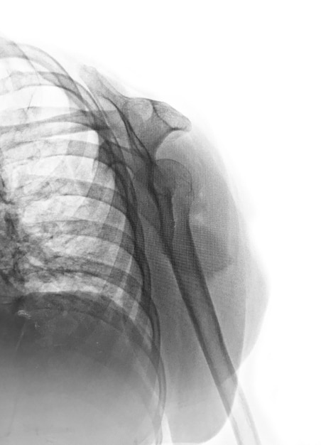 Foto una radiografía de un paciente con un hombro roto.