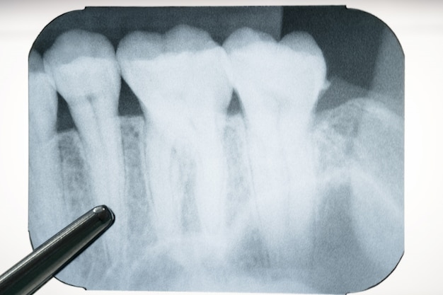 Foto radiografía panorámica dental de la boca.