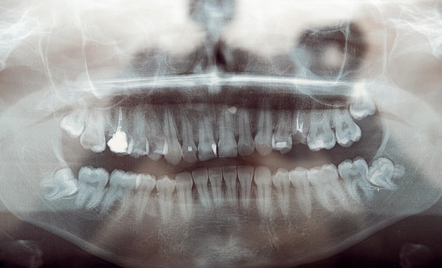 Radiografía panorámica de dientes problema dientes clínica dental primer tratamiento de dientes enfermos