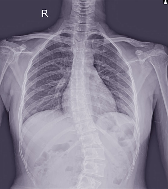 Foto radiografía de película de escoliosis muestra curva espinal en paciente adolescente. enfermedad de la escoliosis