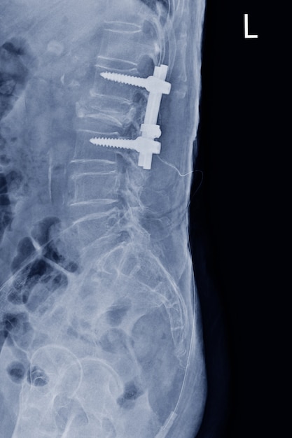 Foto radiografía de película ls-columna vista lateral que muestra una fractura por estallido del cuerpo vertebral l2 con placa y tornillo postoperatorios, concepto de imagen médica.