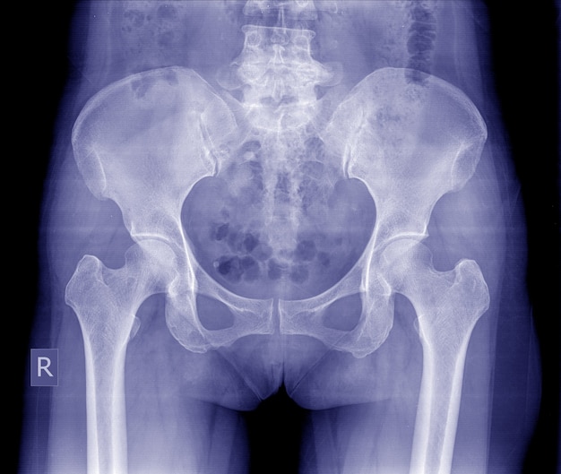 Radiografía de la pelvis y la columna vertebral de una mujer