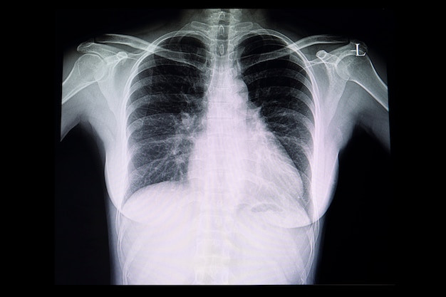 Una radiografía de tórax de un paciente con cardiomegalia.