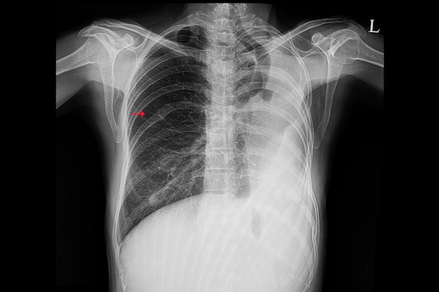 Foto radiografía de tórax de un paciente después de una toracotomía pulmonar izquierda.