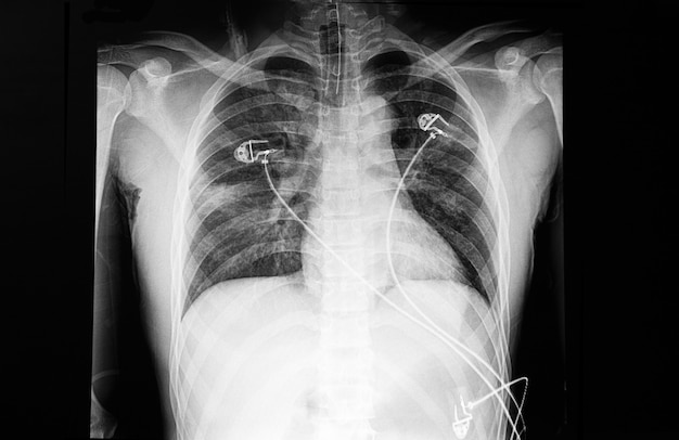 Radiografía de tórax de un paciente con disnea.