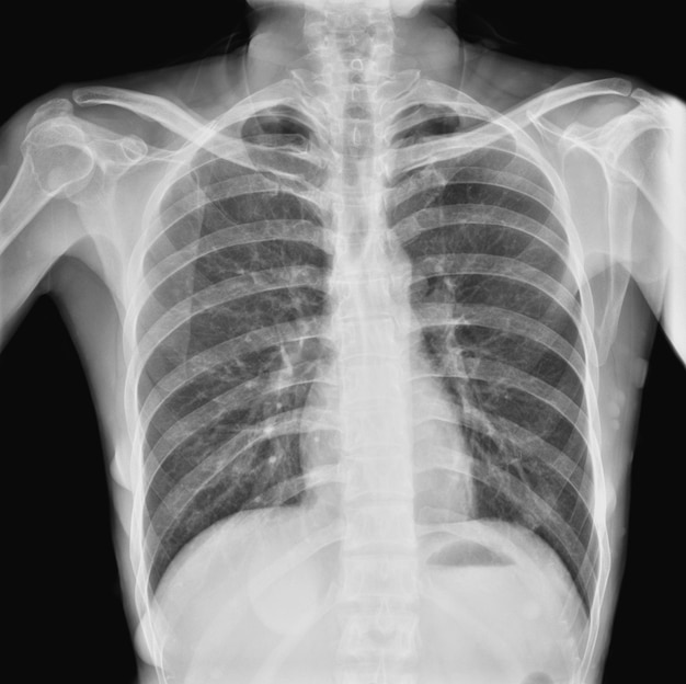 Radiografía de tórax y pulmones.