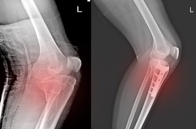 Raio x articulação do joelho fratura da tíbia proximal e fratura pós-tíbia proximal da tíbia.