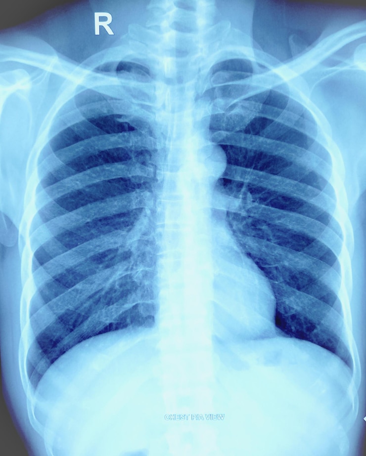 Foto raio-x do tórax humano radiografia do tórax essencialmente normal sem área localizada de infiltrados