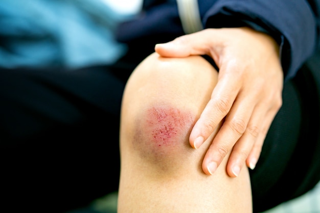Rasguño herido en primer plano de la rodilla femenina, concepto de salud y medicina
