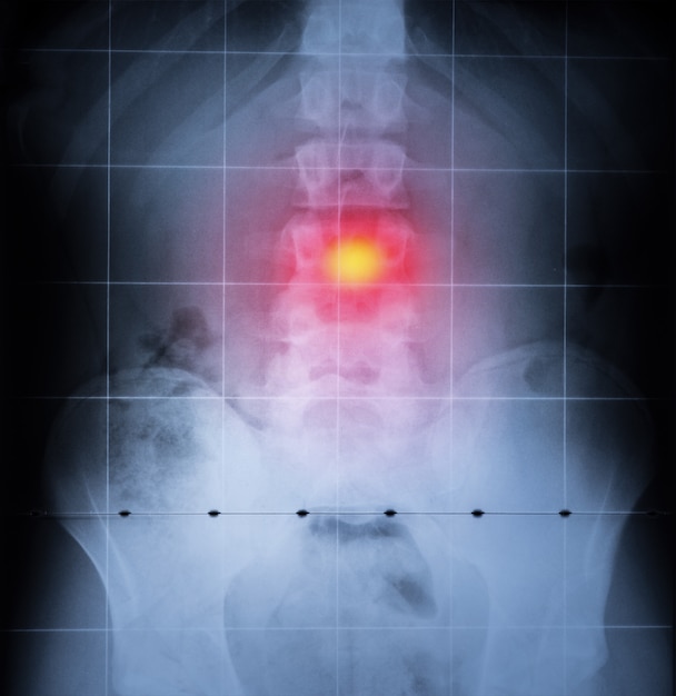 Rayos X, Columna vertebral y pelvis del cuerpo humano. Dolor de espalda resaltado en rojo.